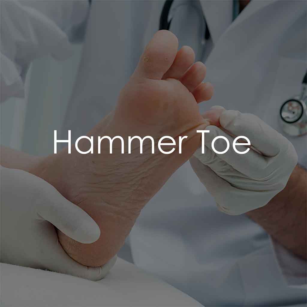 Services - Hammer Toe