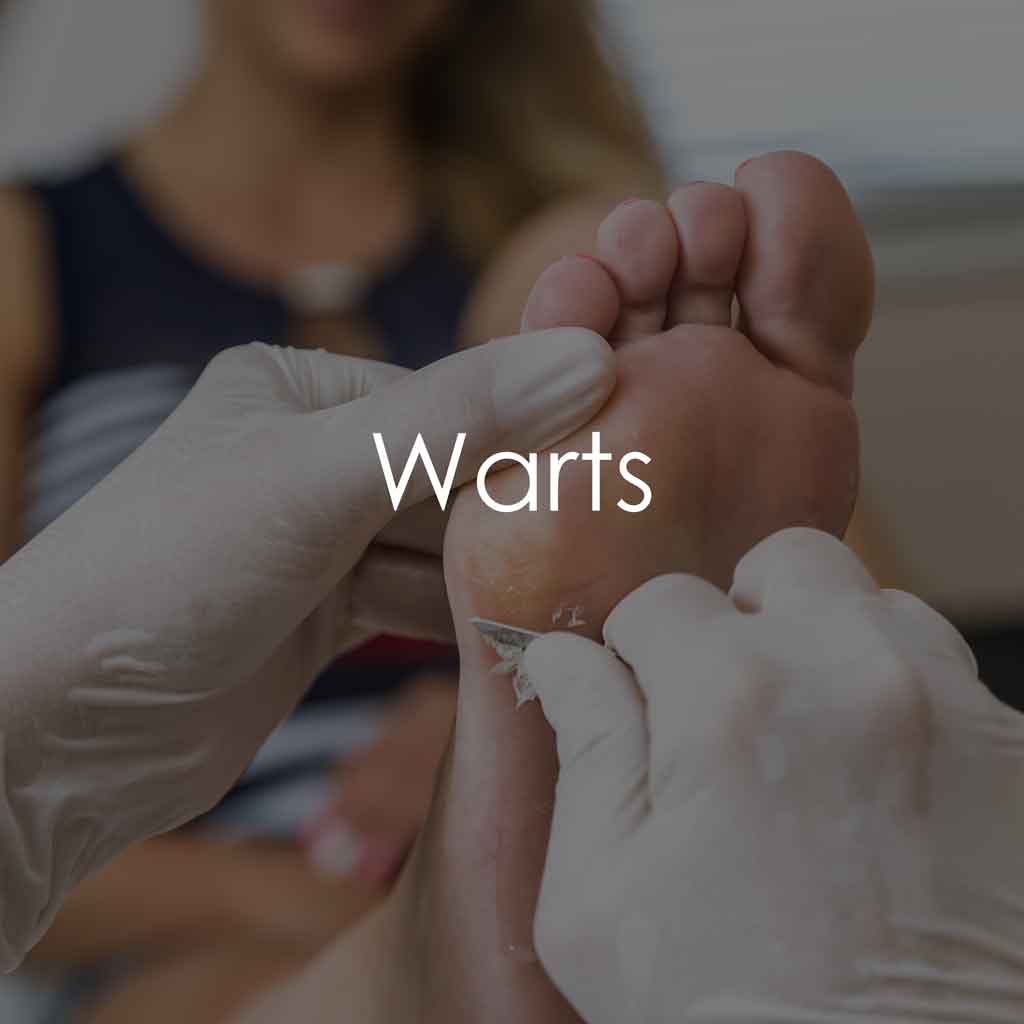 Services - Warts